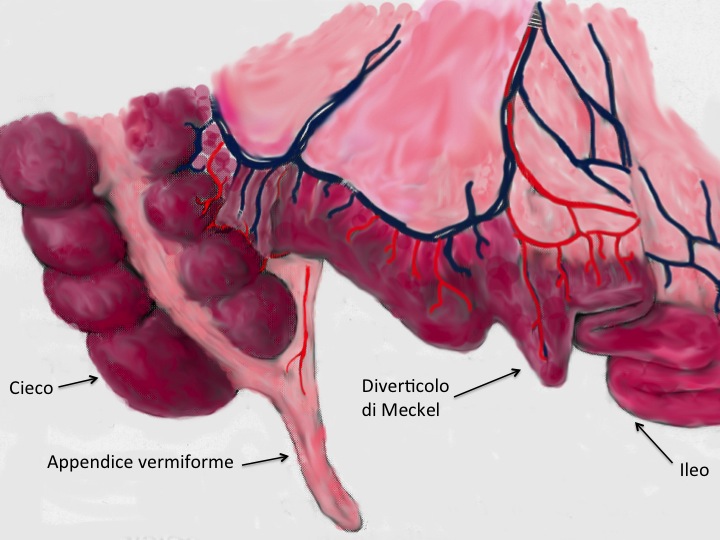 Il diverticolo di&nbsp;Meckel